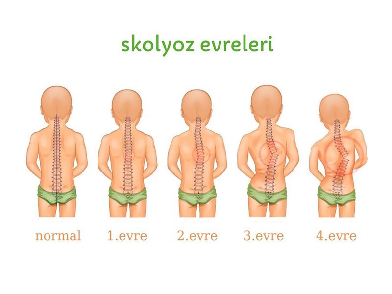 Skolyoz nedir? Belirtileri, Tedavisi...
