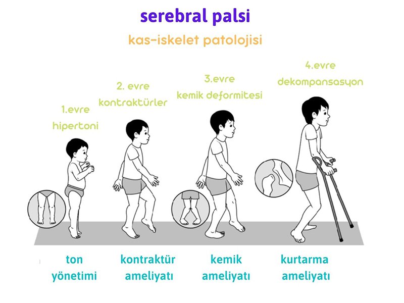 Serebral Palsi