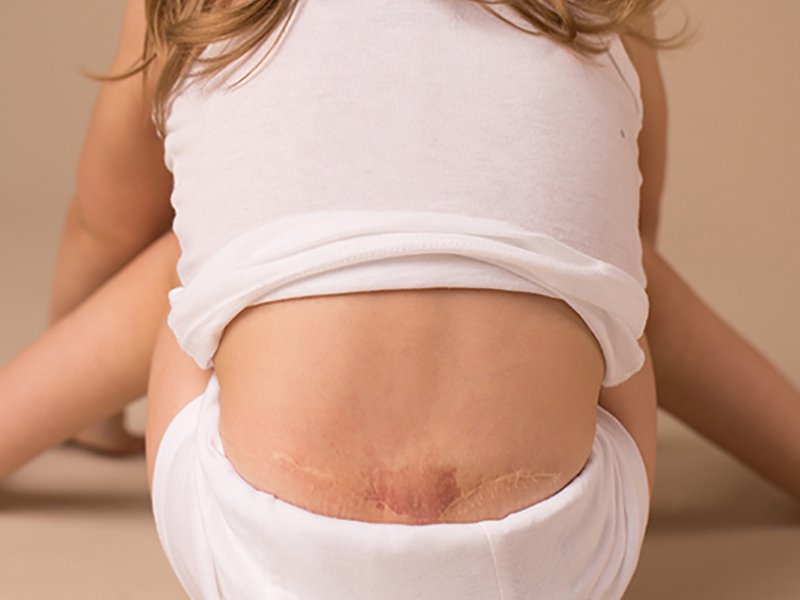 Spina Bifida