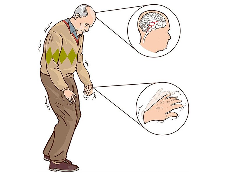 Parkinson Hastalığı