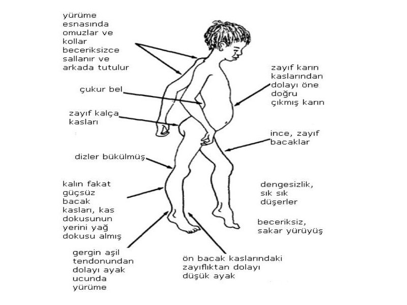 DMD Hastalığı
