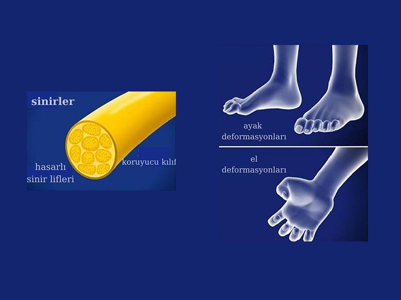 Charcot Marie Tooth Hastalığı