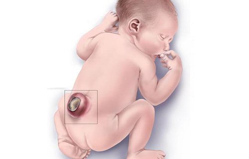 Spina Bifida