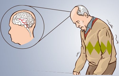 Parkinson Hastalığı