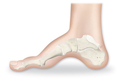 Charcot Marie Tooth Hastalığı
