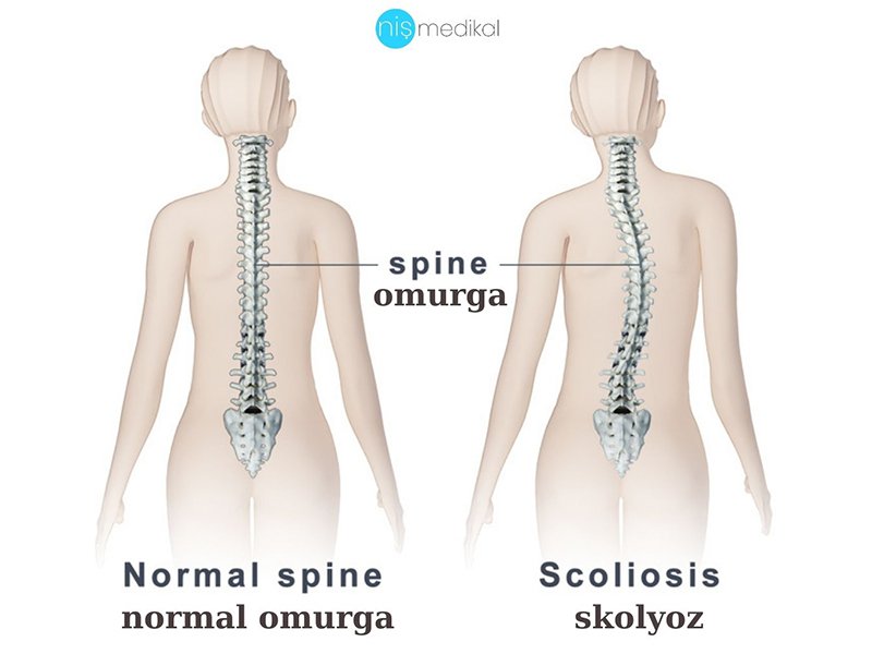 Skolyoz nedir? Belirtileri, Tedavisi...